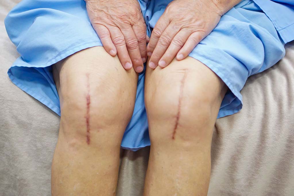 knee-replacement-types-benefits-and-cost-of-surgery-in-india